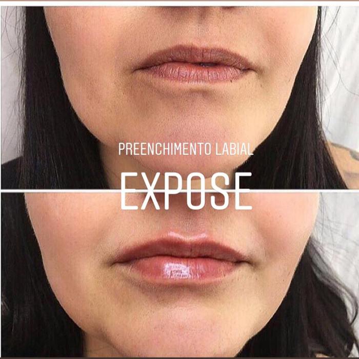 Preenchimento Facial e Labial - EXPOSE Saúde Estética Beleza