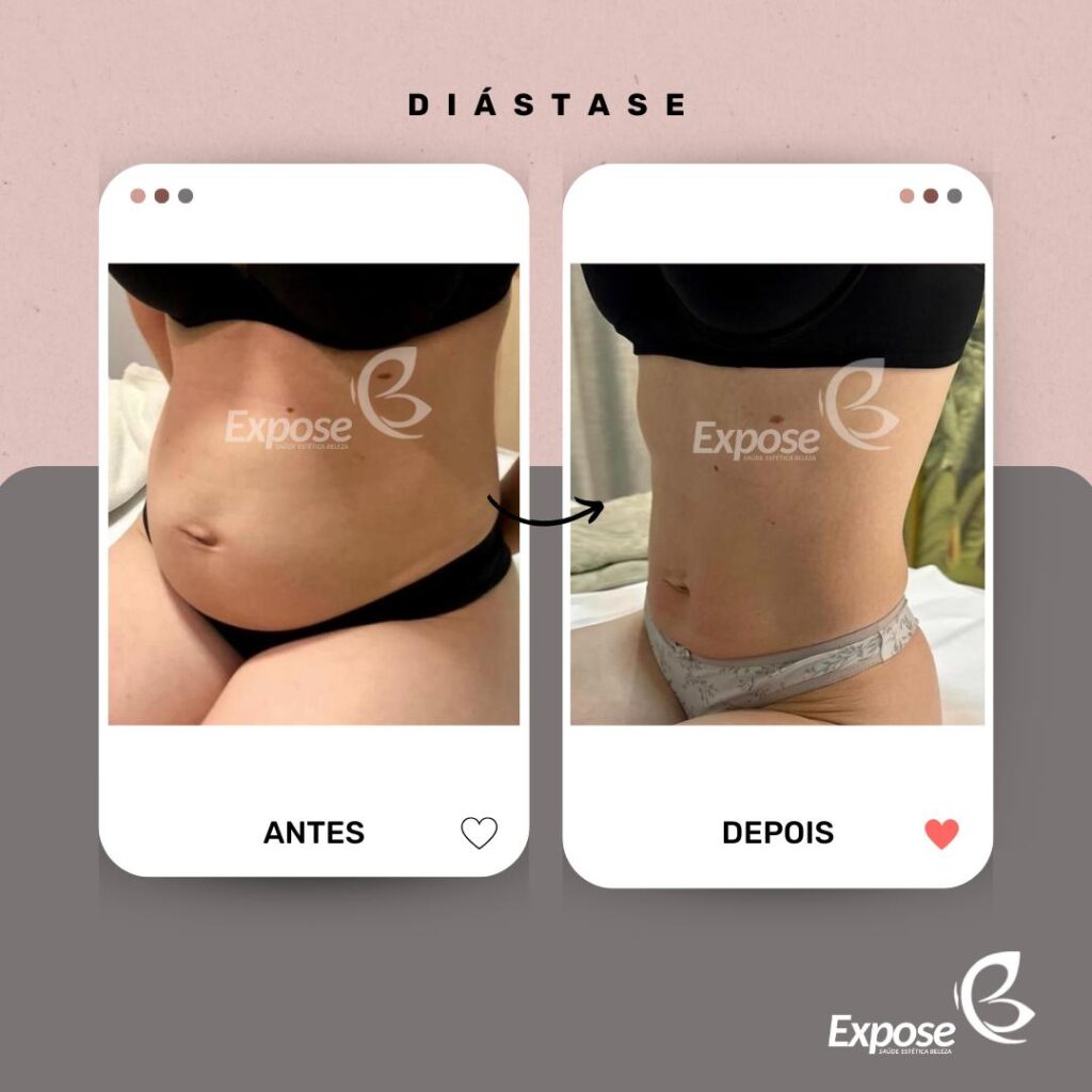 Diástase Abdominal: Entenda, Cuide e Descubra o Caminho Para Um Abdômen Firme e Funcional